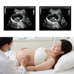 산전 기형아 선별검사 임신부 초음파 검사 모식도